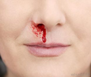 close-view-of-nose-bleeding – Learn Tetun